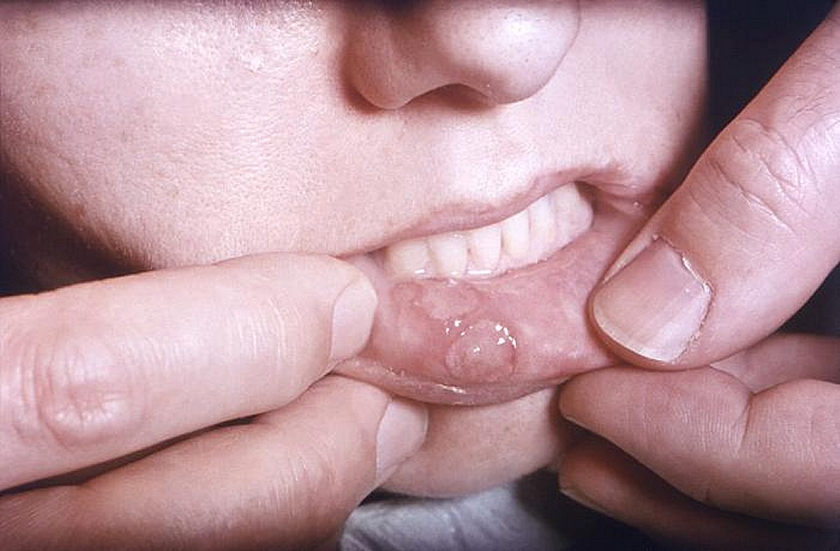 Aphthous Stomatitis